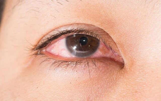 sau-khi-mo-mat-can-thi